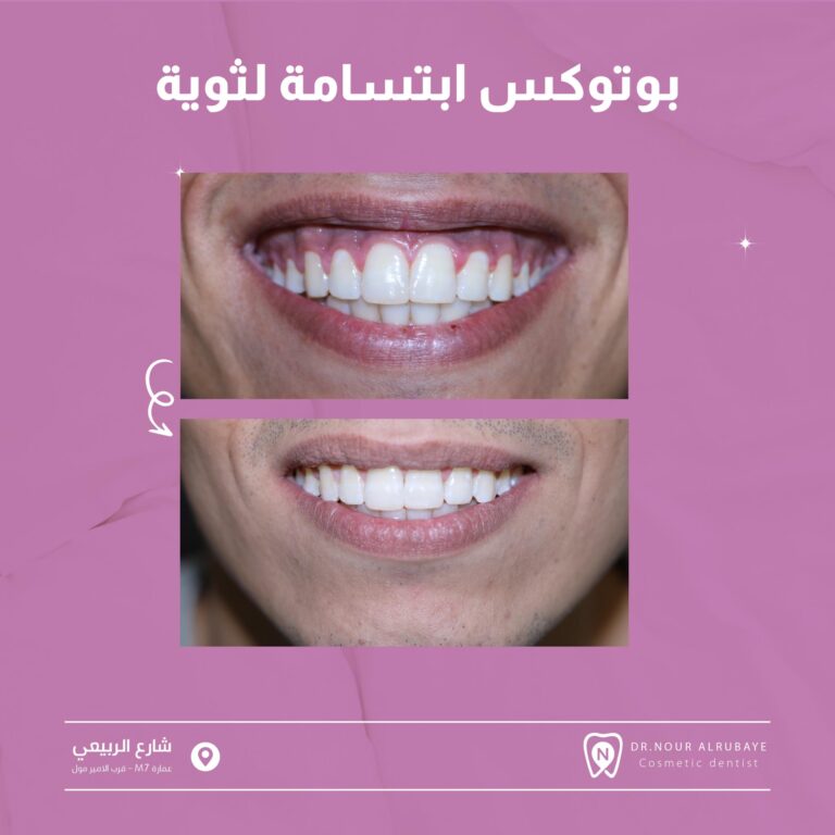 بوتكس ابتسامه لثويه 768x768