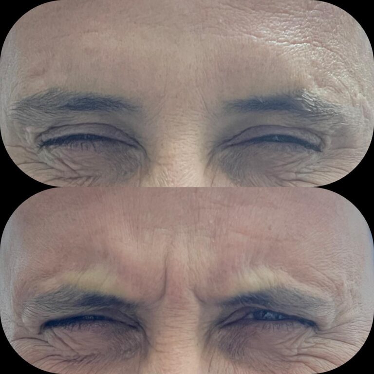 بوتكس ازالة التجاعيد 768x768