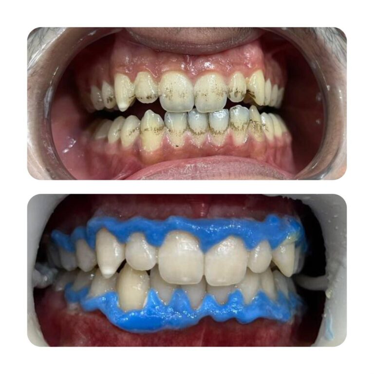 تبييض الاسنان باليزر 768x768