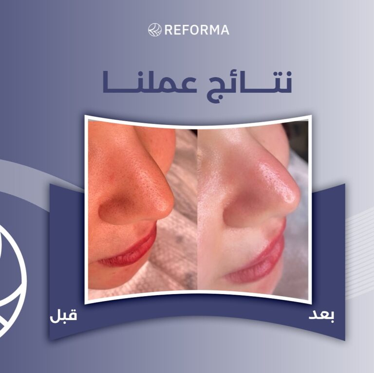 تبييض الشبره 768x767