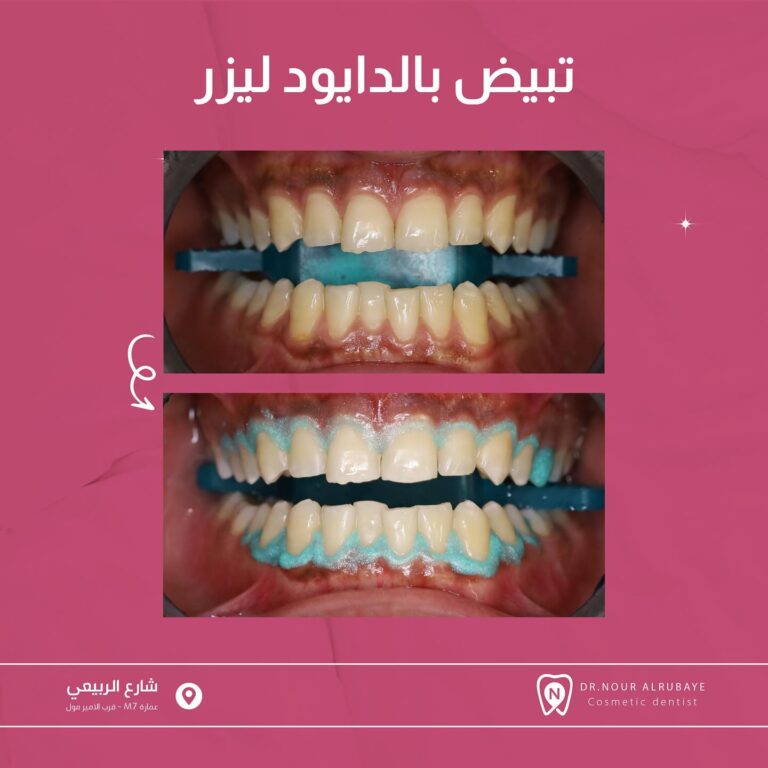 تبييض بالليزر 768x768
