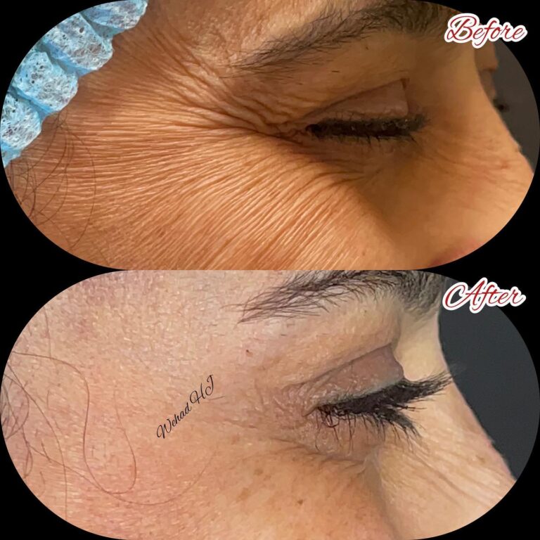 تجاعيد تحت العين 768x768