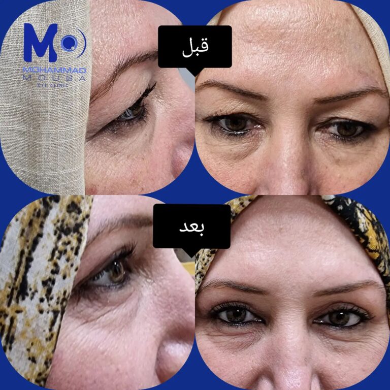 تجميل الاجفان 1 768x768