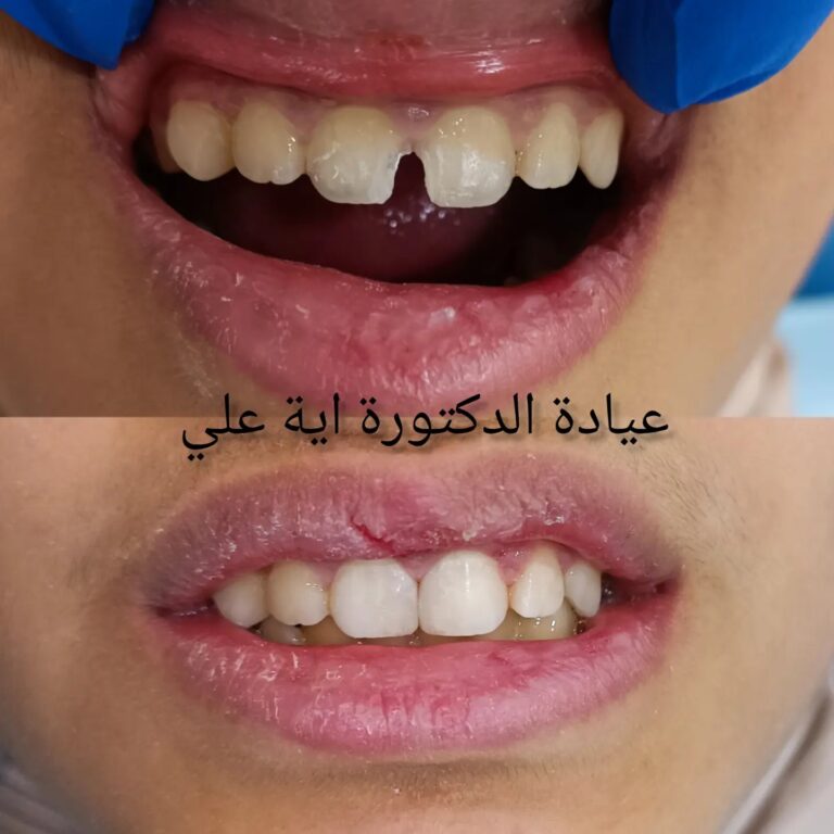 تجميل الاسنان 768x768