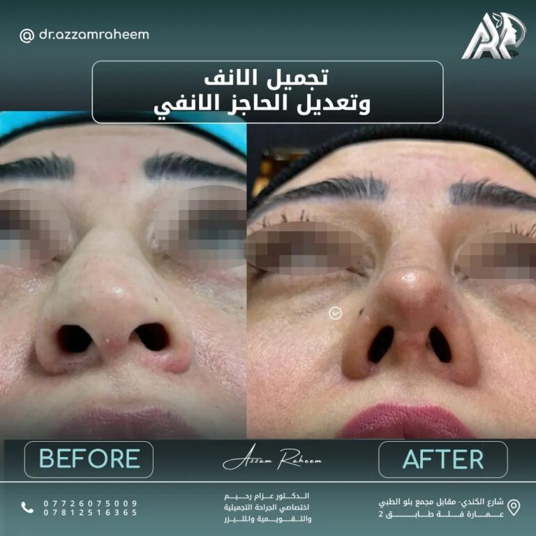 تجميل الانف 1 768x768