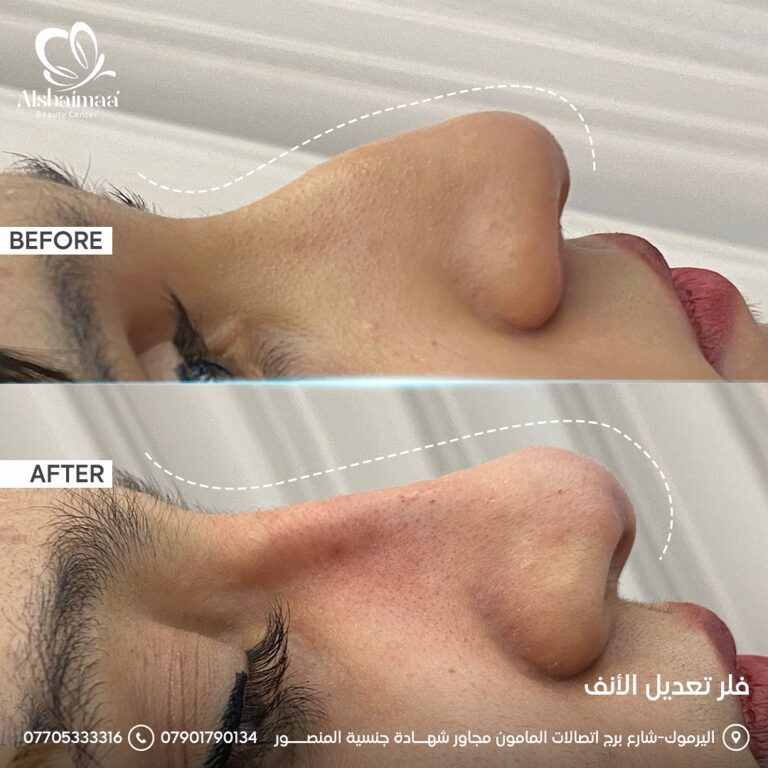 تجميل الانف 3 768x768