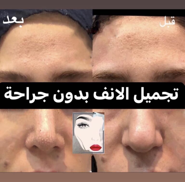 تجميل الانف 4 768x758