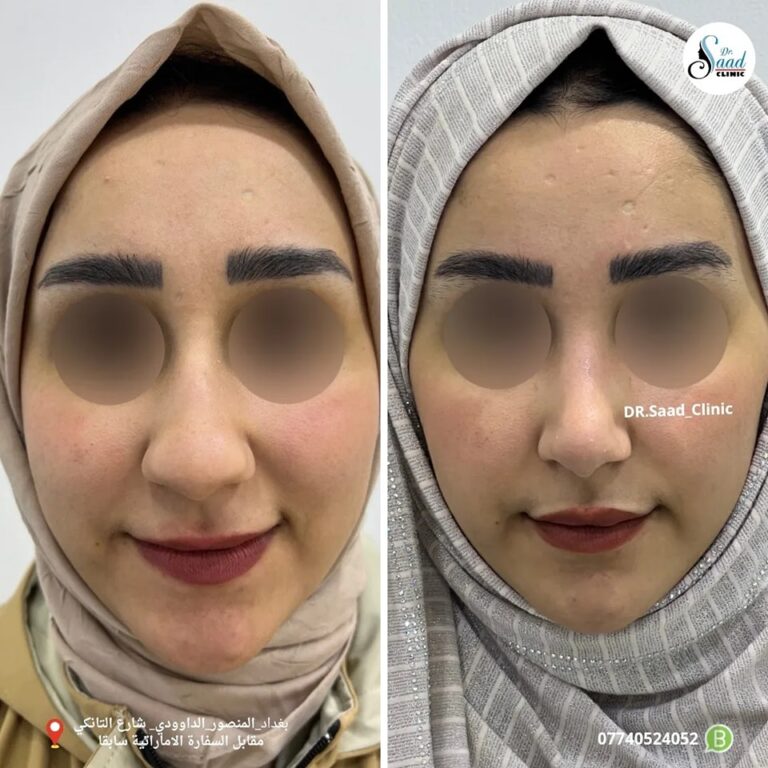 تجميل الانف 5 768x768