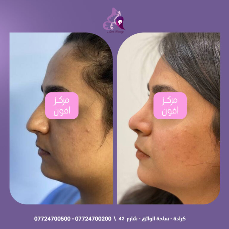 تجميل الانف 8 768x768