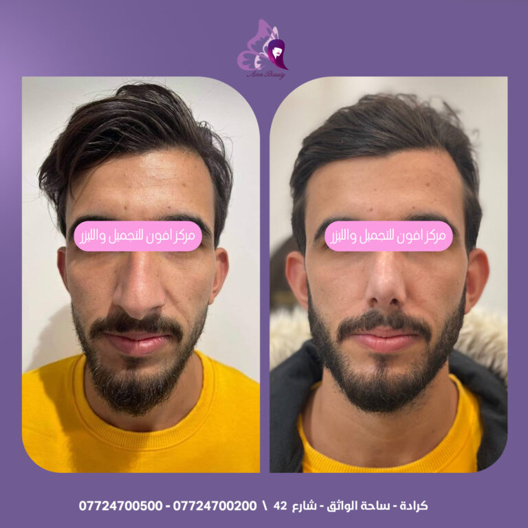 تجميل الانف للرجال 768x768