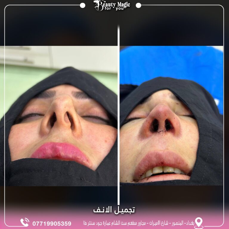 تجميل انف 1 768x768