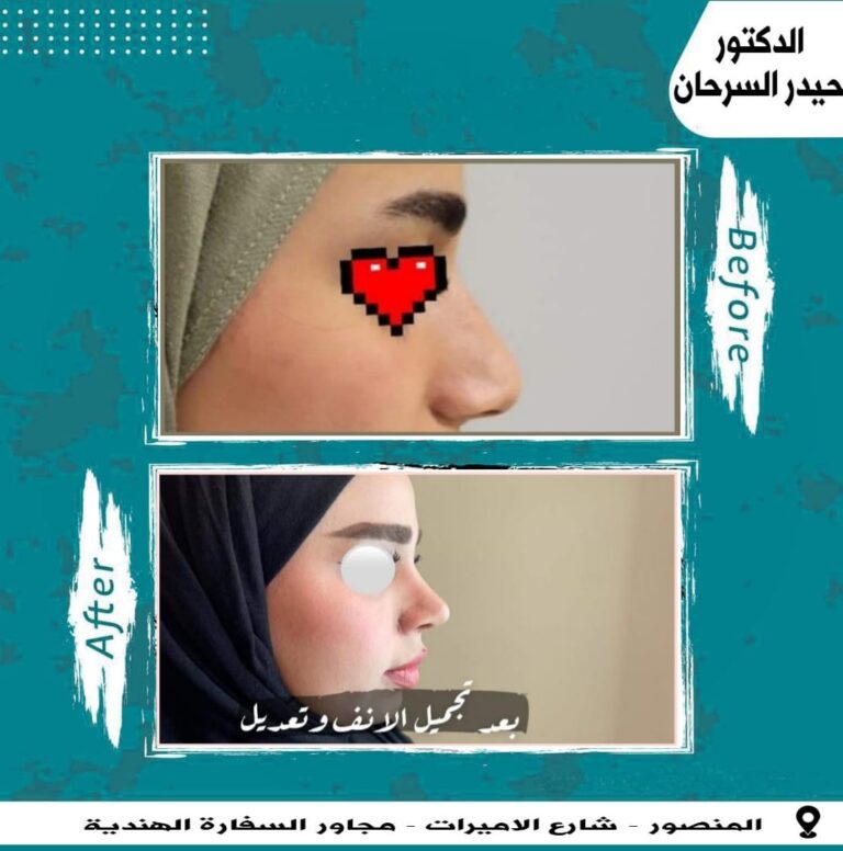 تجميل انف 2 768x776