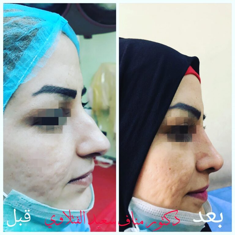 تجميل انف 3 768x768