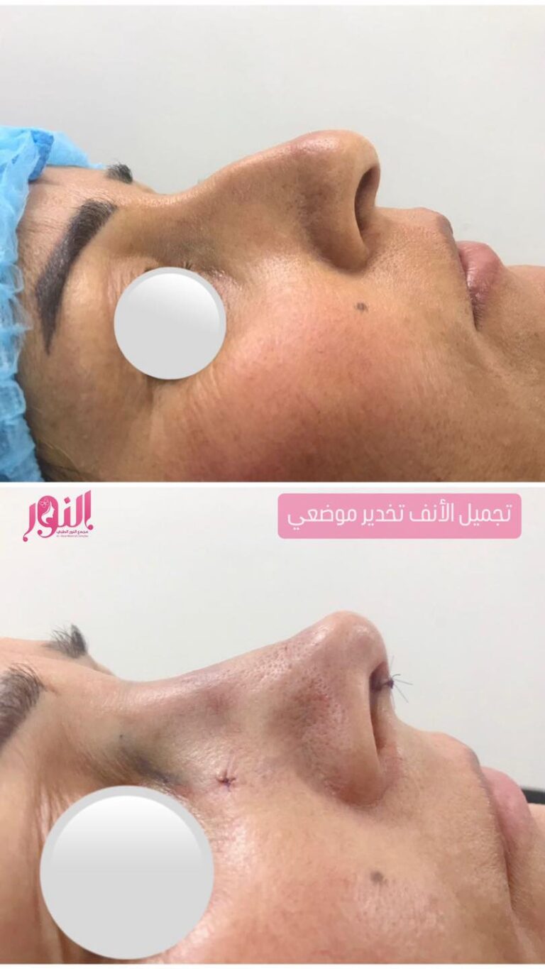 تجميل انف 4 768x1365