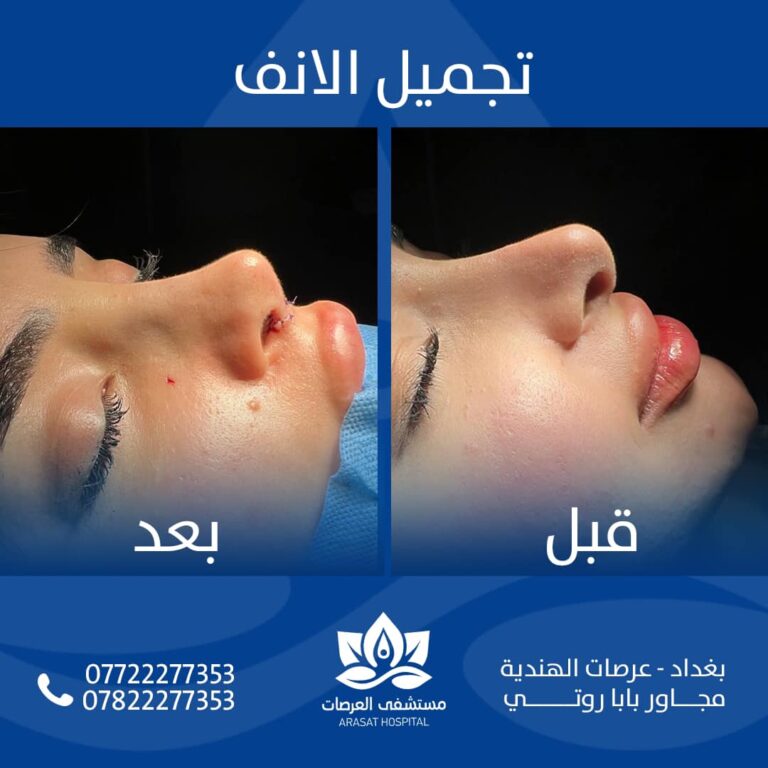 تجميل انف 768x768