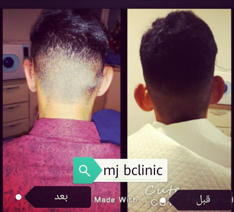 تجميل بروز الاذن 768x694