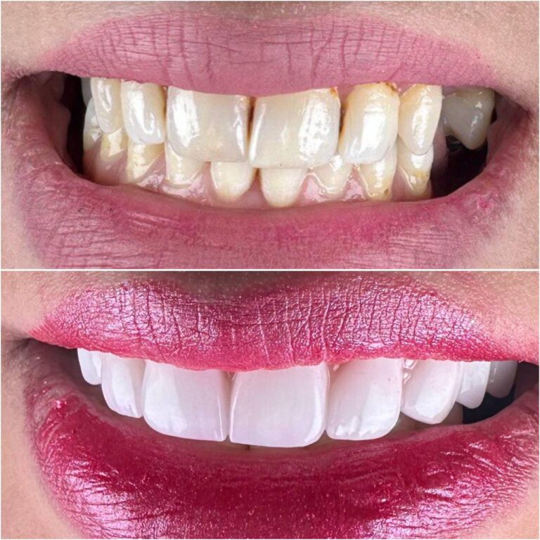 تركيب زاركون 1 768x768