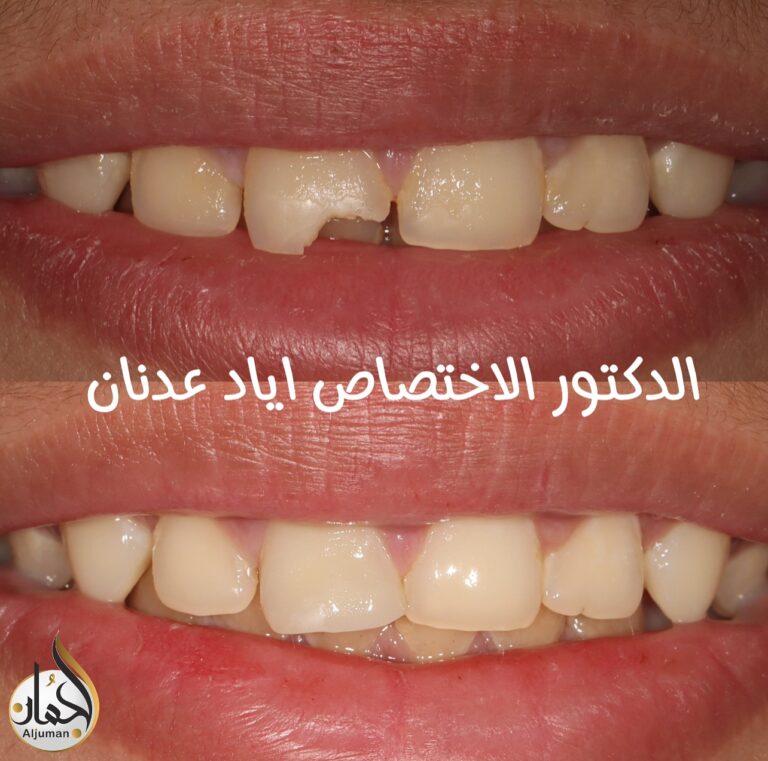 ترميم اسنان 768x761