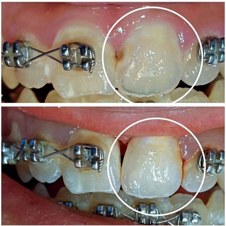 ترميم الاسنان 768x768