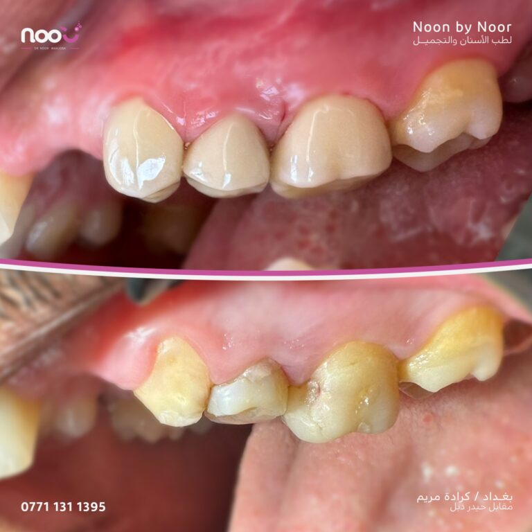 ترميم الضواحك 768x768