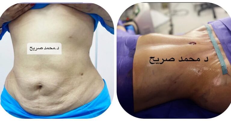 ترهلات البطن 768x402