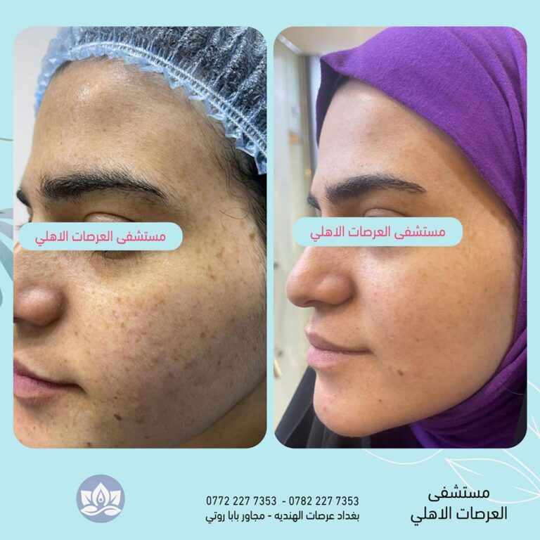 تصبغات الوجه 768x768