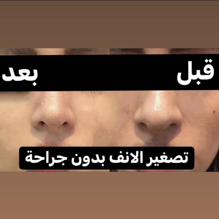 تصفيير الانف 768x767