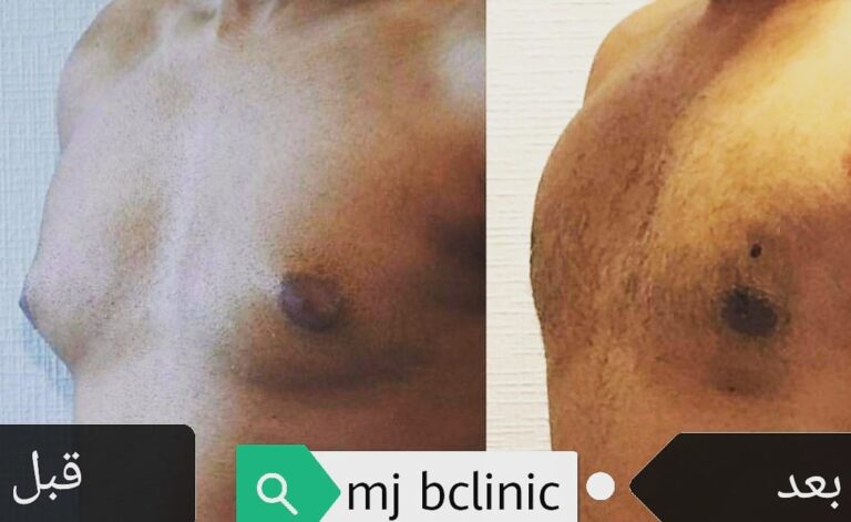 تضخم الثدي عند الرجال 768x471