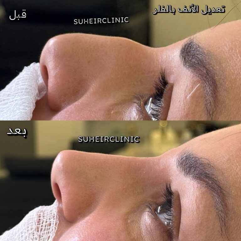 تعديل الانف بالفلر 1 768x768
