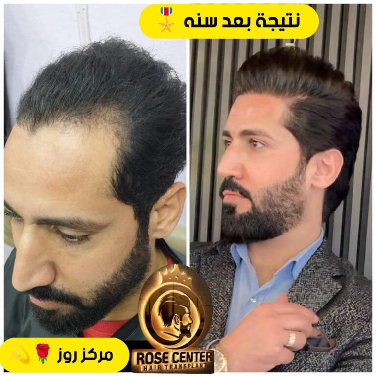 تعويض الشعر 768x768