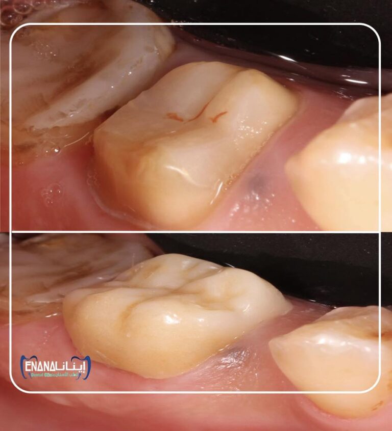 تغليف سن زاركون 768x846