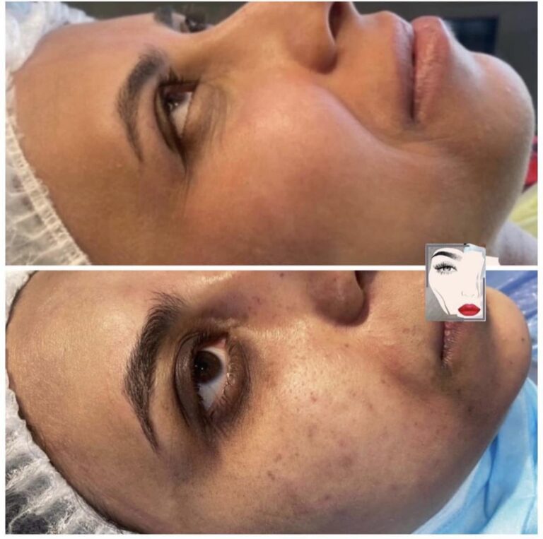 تقليص المسامات المفتوحه 768x763