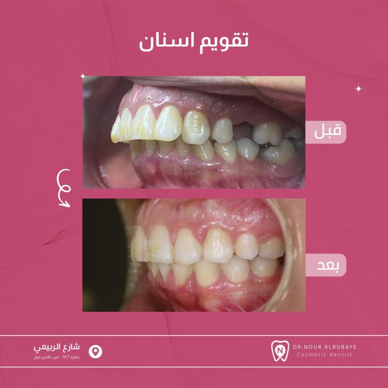 تقويم اسنان 768x768