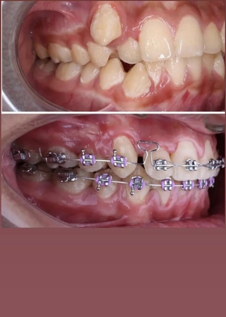 تقويم الاسنان 2 768x1078