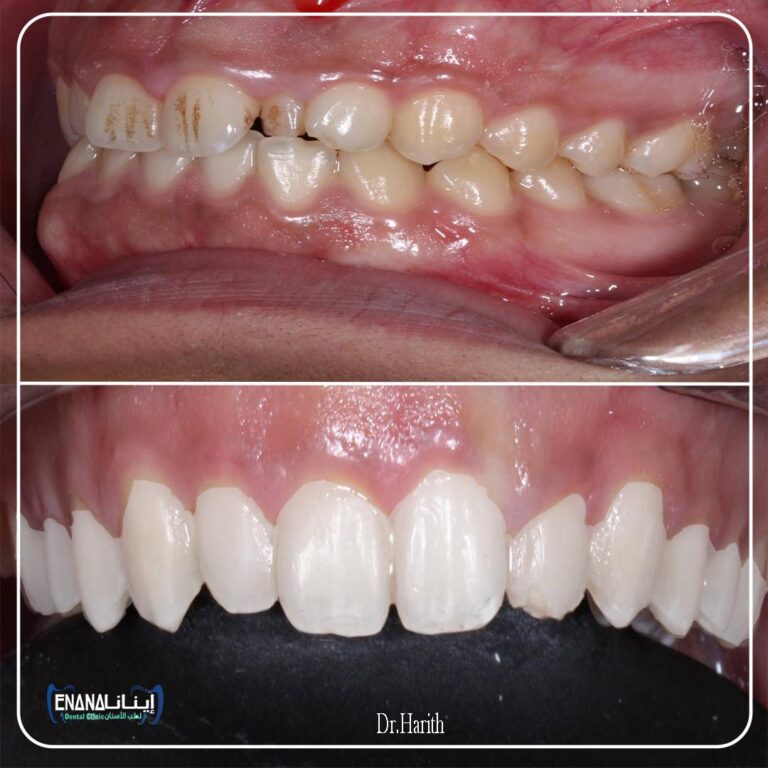 تقويم الاسنان واعاد الابتسامه 768x768