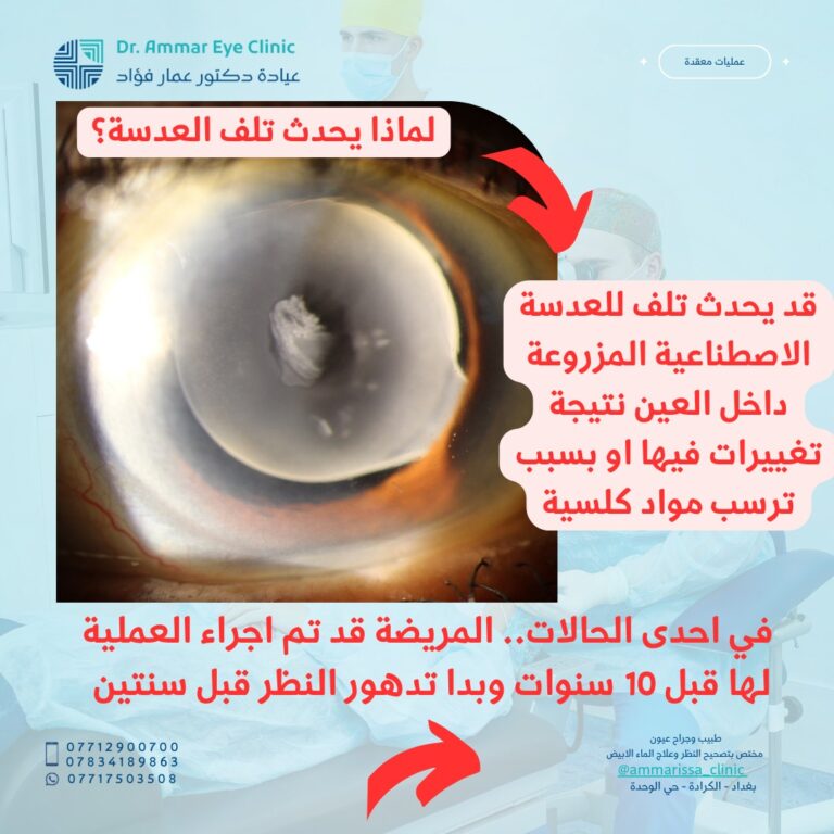 تلف العين 768x768