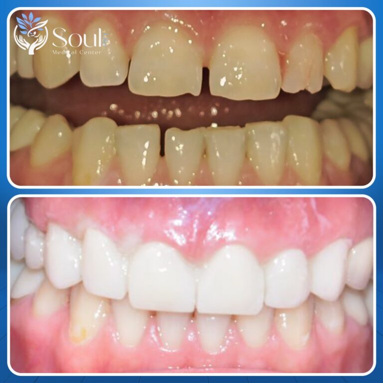 تنظيف اسنان 768x768