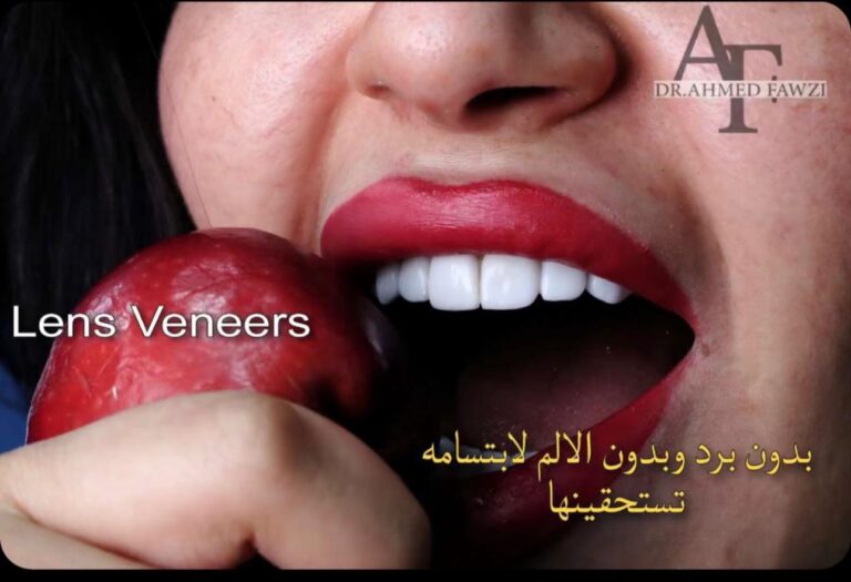 تنظيف الاسنان بالليزر 768x525