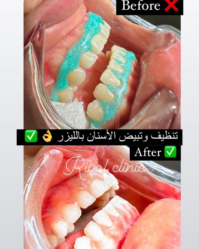 تنظيف وتبيض الاسنان باليزر 768x960