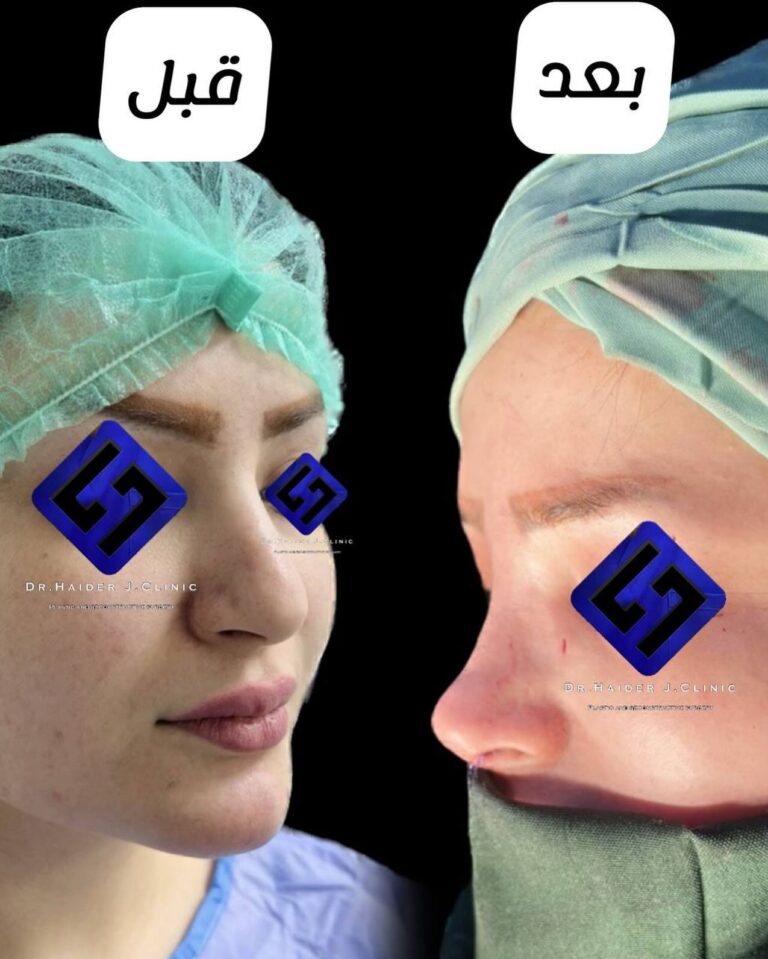 جراحه انف 768x959