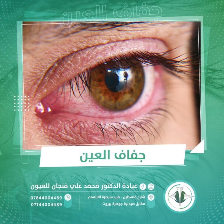 جفاف العين 6 768x768