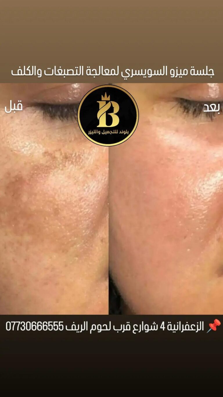 جلسه تصبغات وكلف 768x1365