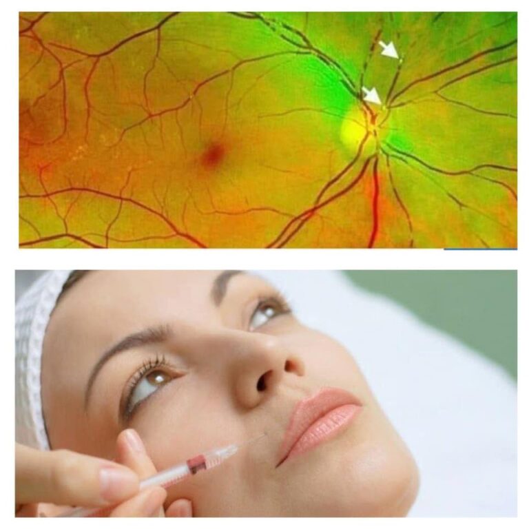 جلطه الشريان 768x768