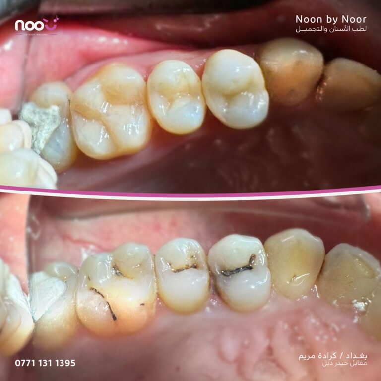 حشوات ضوئيه 768x768