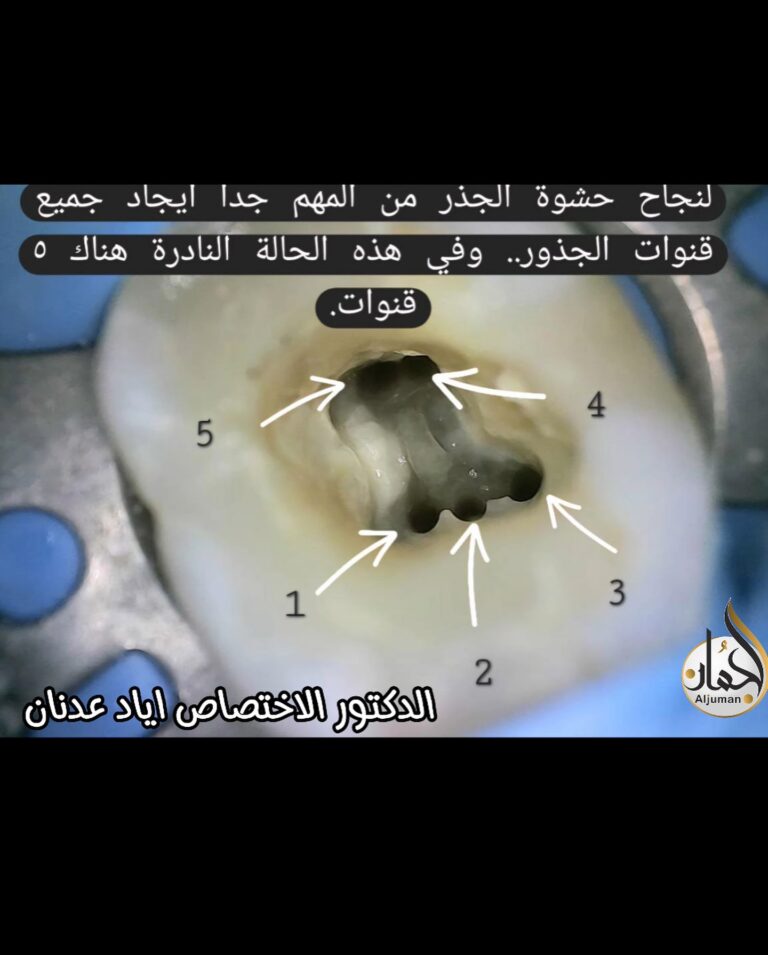 حشوة جذر 768x955