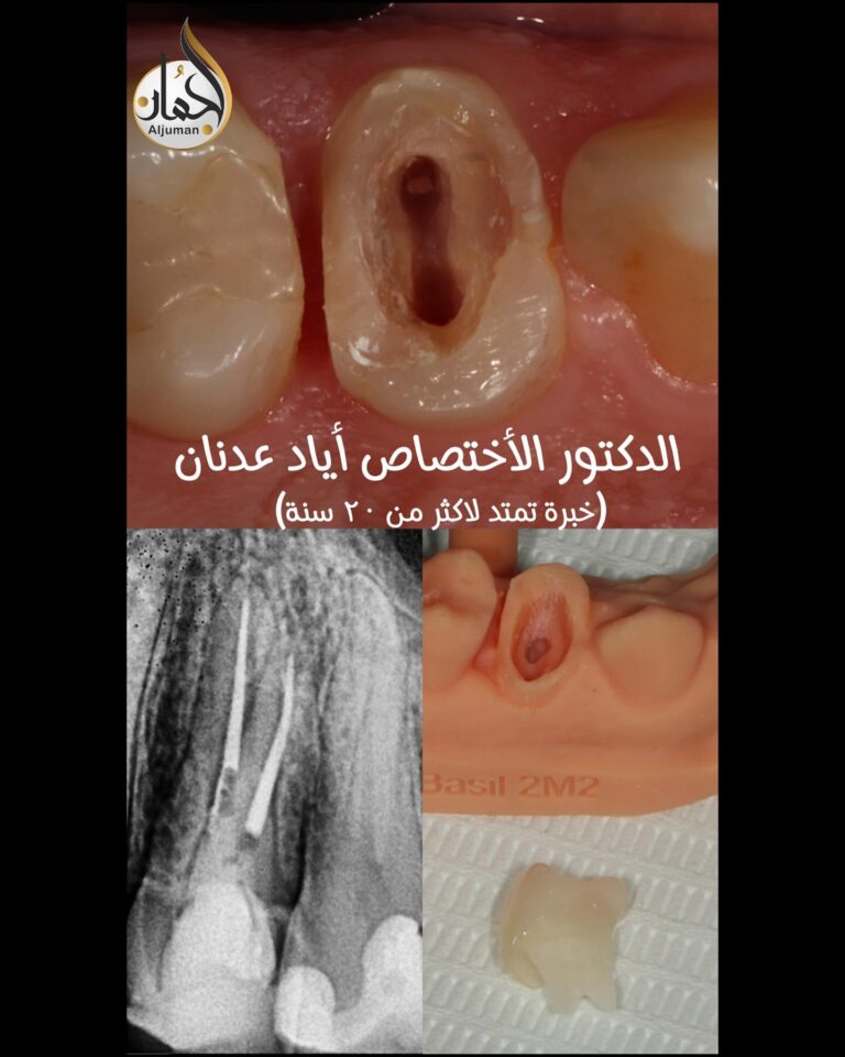 حشوه اسنان 768x960