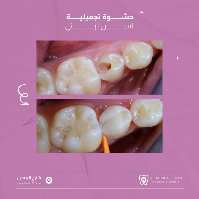 حشوه تجميل 768x768