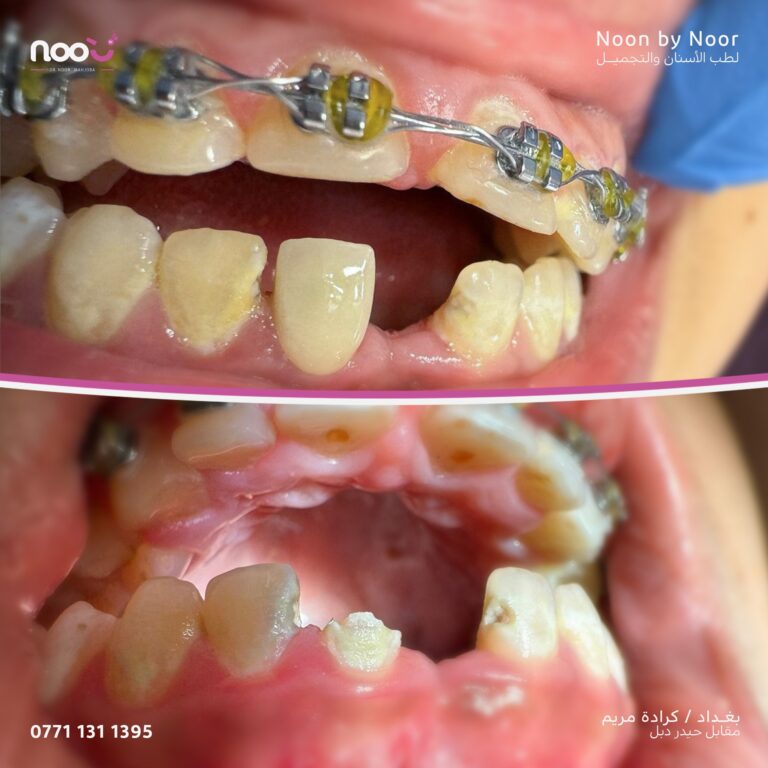 حشوه جذر 768x768