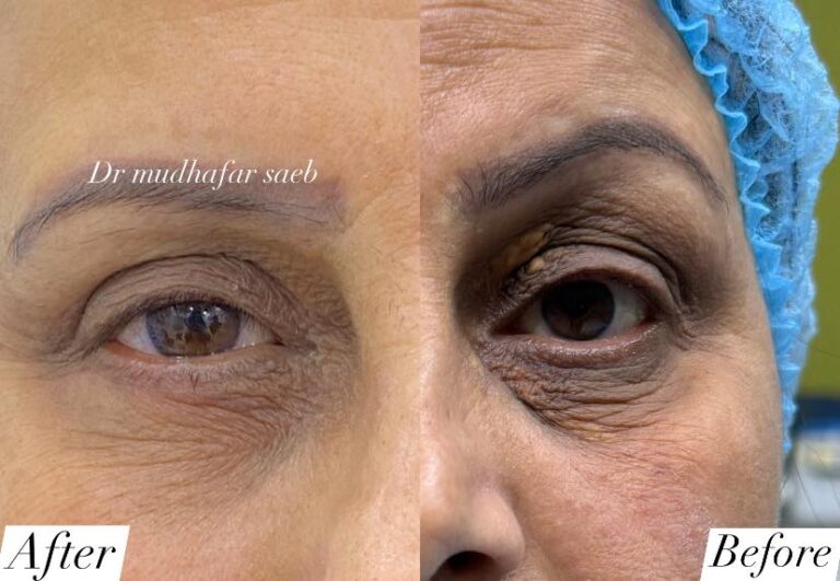 حقن اجفان 768x531