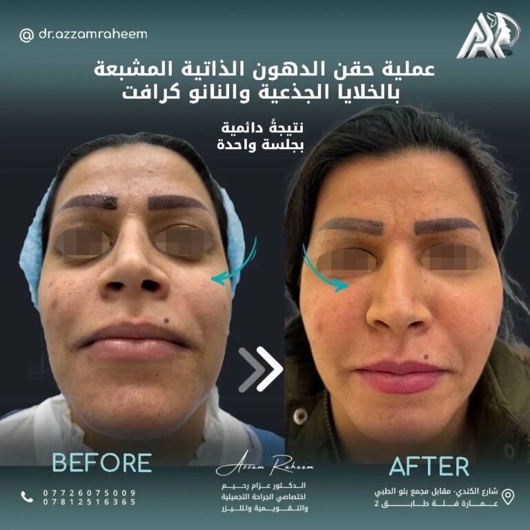 حقن الدهون الذاتيه 768x768